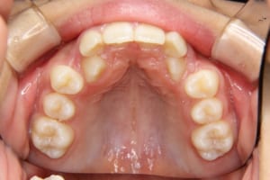 犬歯が左右とも口蓋側に生えています
